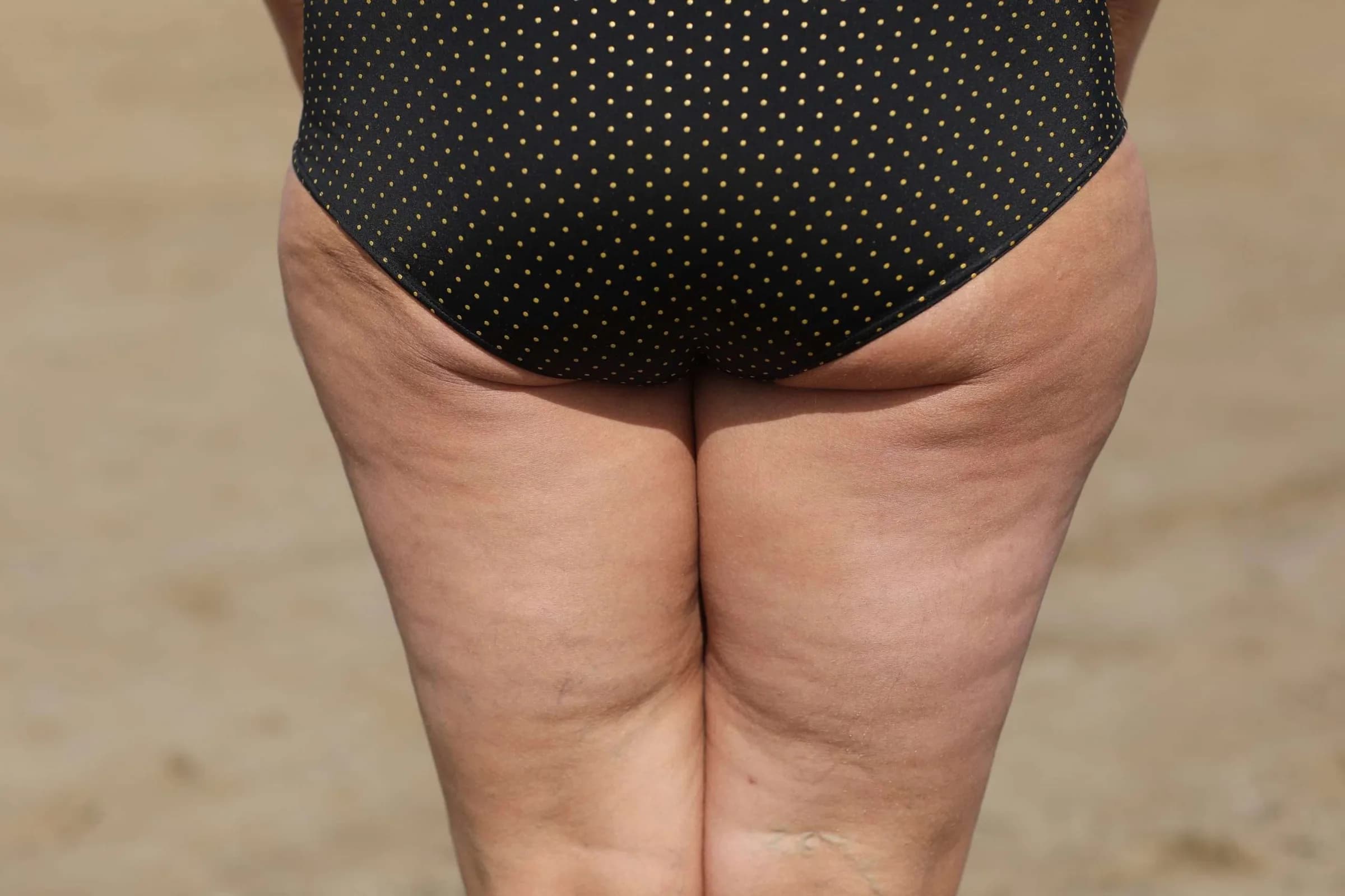 How to Tell the Difference Between Cellulite and Early-Stage Lipedema