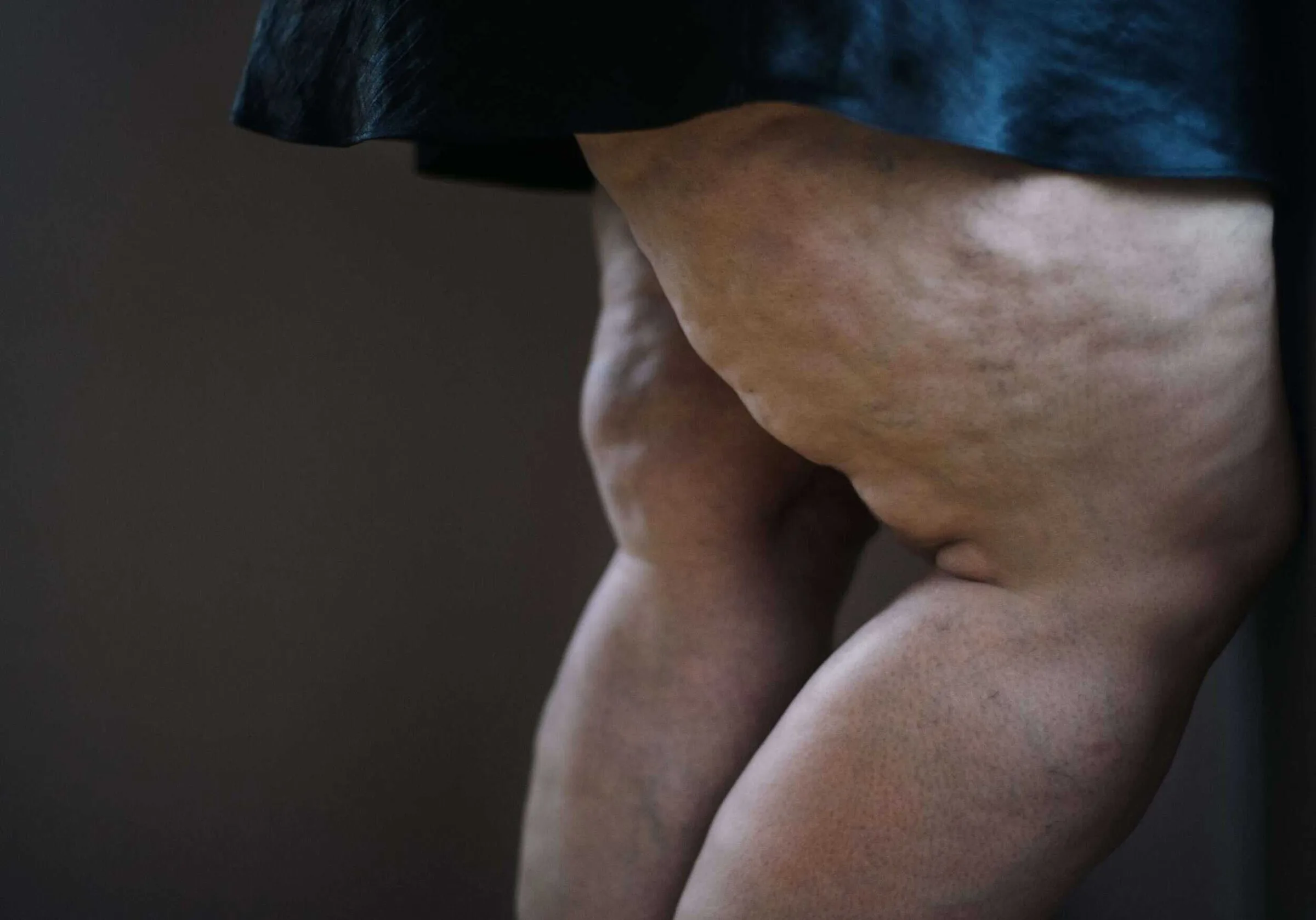 What is Lipedema? Dr. Jonie Girouard Explains…